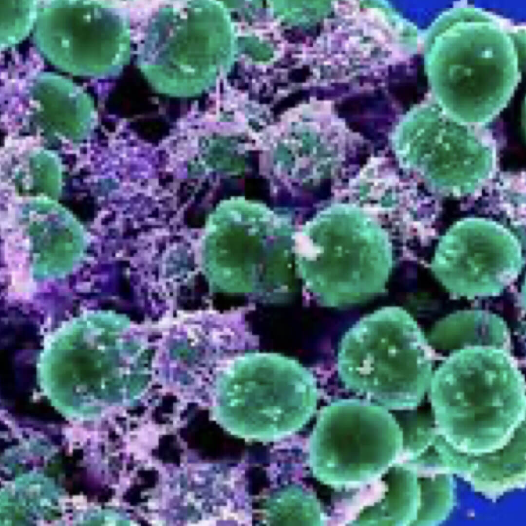 Staphylococcus Epidermidis and Staphylococcus Sp.